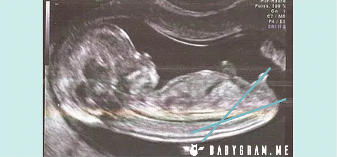 The nub theory applied to a boy nub