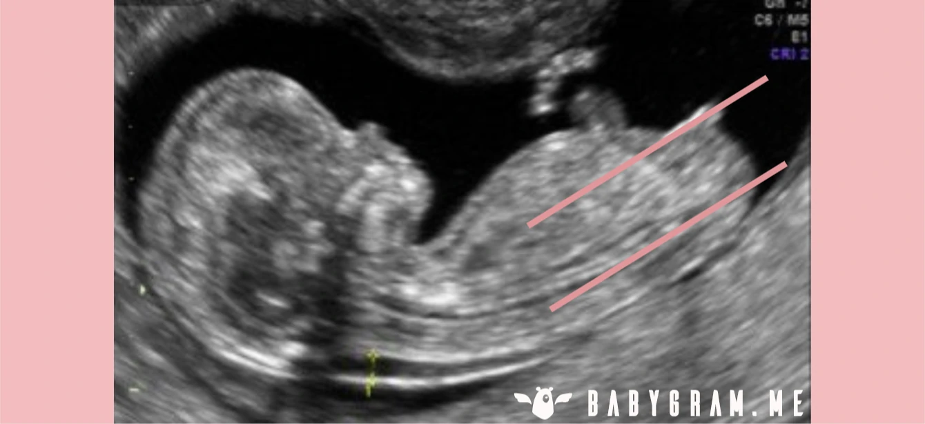 The nub theory applied to a girl nub